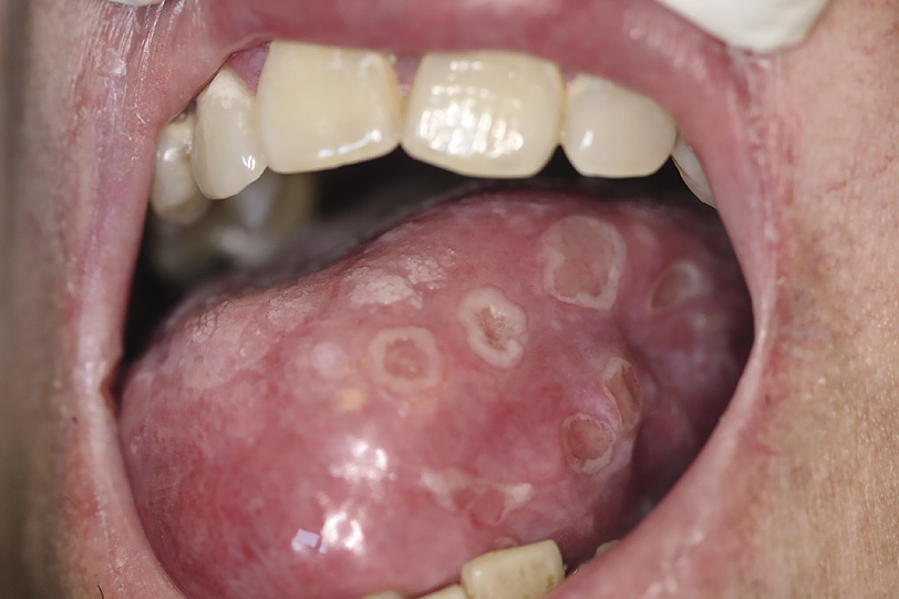признаки вторичного сифилиса во рту