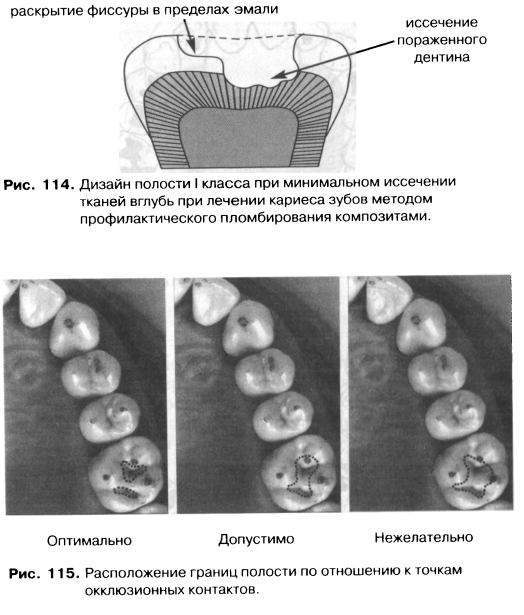 Кариес дентина мкб. Фиссуры зубов схема. Типы строения фиссур. Расположение окклюзионных контактов зубов.